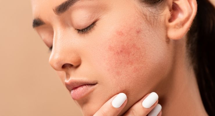 Acne: sintomi, cause, cure e rimedi