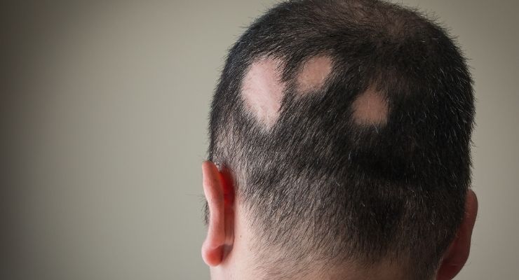 Alopecia: capire la perdita di capelli