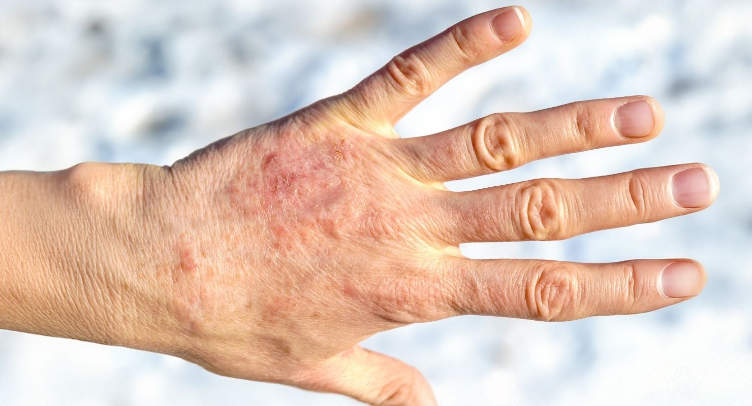 Mani ruvide in inverno: come trattarle e prevenirle