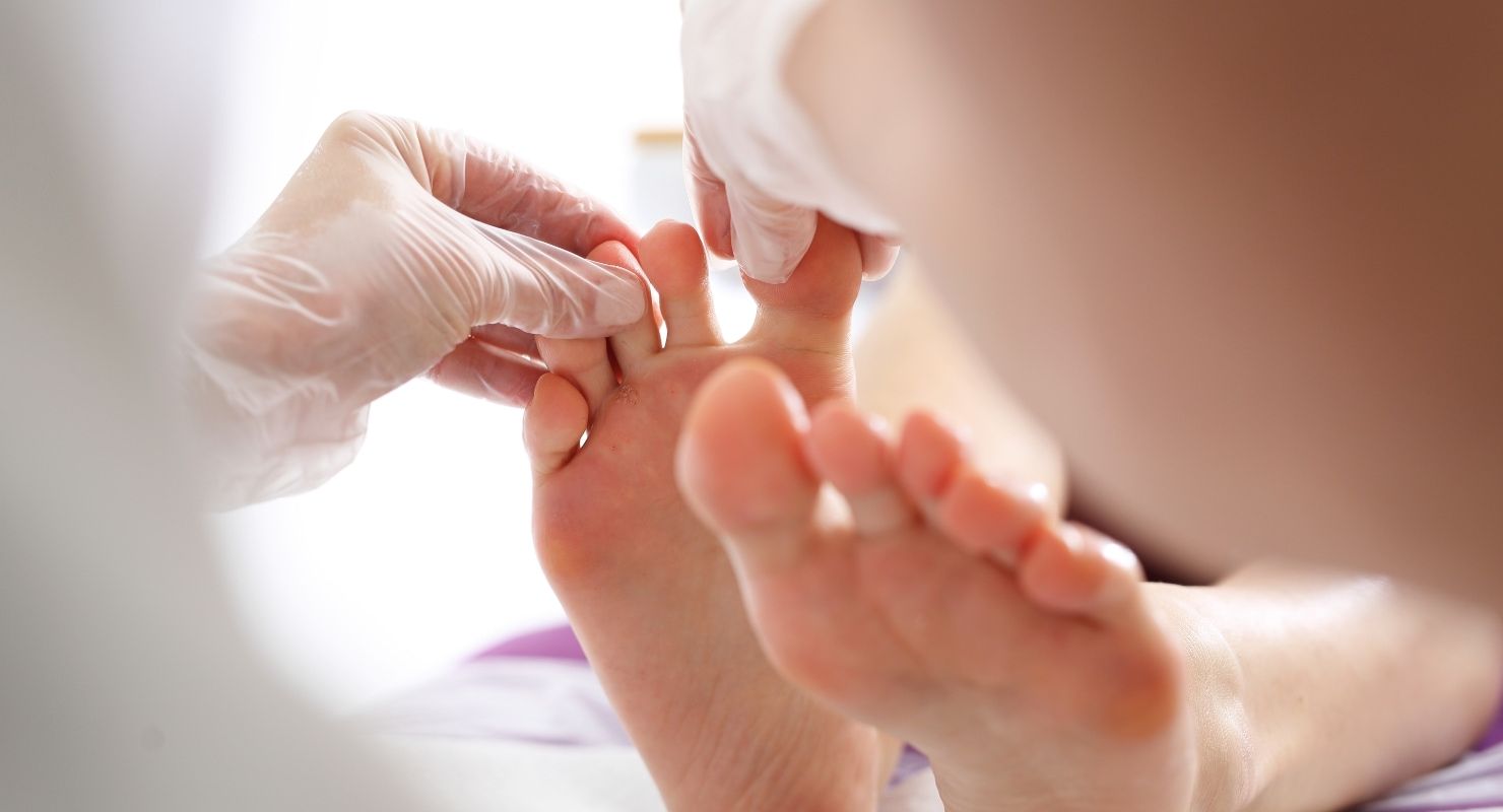 Piede e micosi: come riconoscerla, curarla e prevenirla