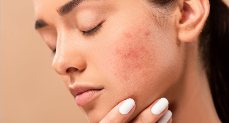 Acne: sintomi, cause, cure e rimedi