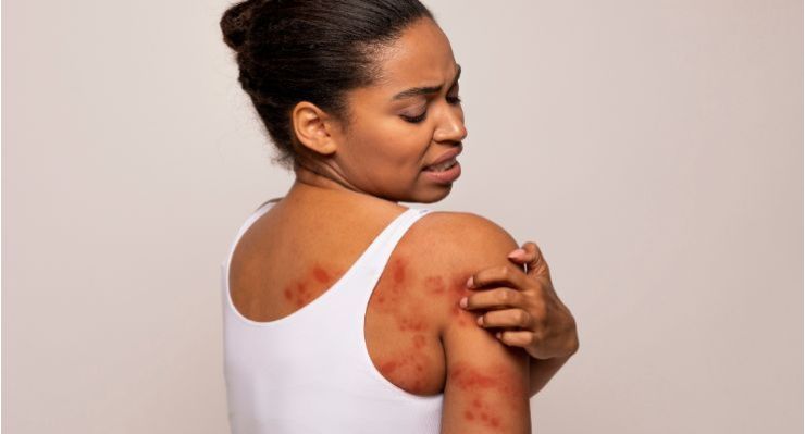 Dermatite seborroica: sintomi, cause e rimedi